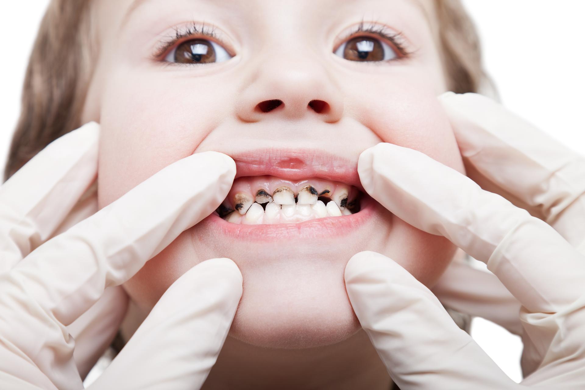 Causes and Remedies for Teeth Discoloration in Children